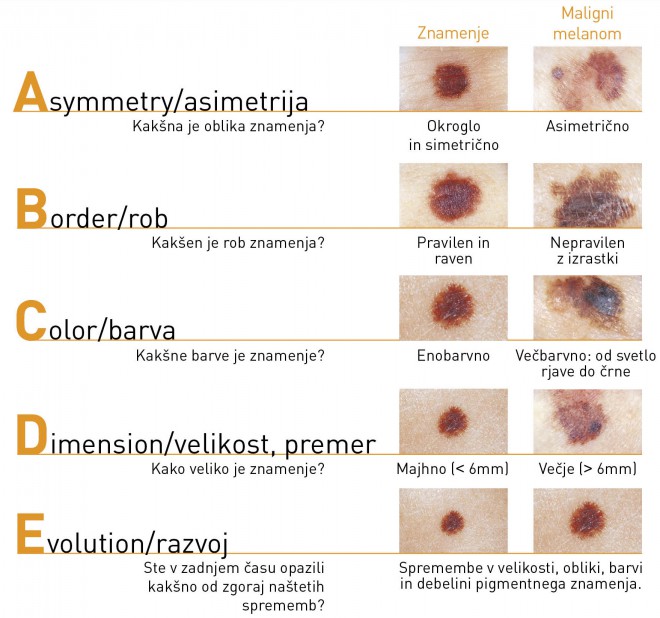 Kožni rak - ali bi ga prepoznali?